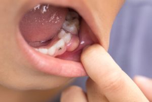 can a toothache cause ear pain decay
